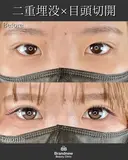 二重埋没＋目頭切開 after画像 サムネイル用