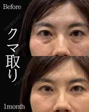 岩切医師による🔥クマ取り🔥 before画像 サムネイル用