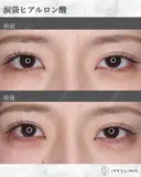 ヒアルロン酸(涙袋) after画像 サムネイル用