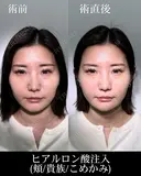 ヒアルロン酸注入（頬/貴族/こめかみ） before画像 サムネイル用