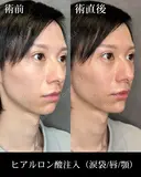 ヒアルロン酸注入（涙袋/唇/顎） before画像 サムネイル用