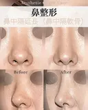 鼻中隔延長 after画像 サムネイル用
