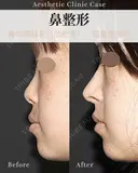 鼻中隔延長 after画像 サムネイル用