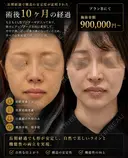 鼻フルカスタム(肋軟骨) after画像 サムネイル用