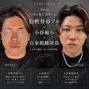 鼻フルカスタム before画像 サムネイル用