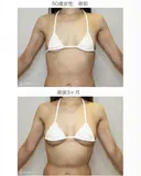 【50歳女性・柔らかく自然で綺麗なバスト】プレミアムセリューション豊胸術（3ヶ月後） 90日後 サムネイル用
