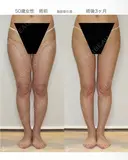 【50歳女性・柔らかく自然で綺麗なバスト】プレミアムセリューション豊胸術（3ヶ月後） 90日後 サムネイル用