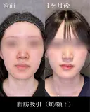 脂肪吸引(頬/顎下) before画像 サムネイル用