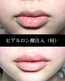 ヒアルロン酸注入(唇) 0日後 サムネイル用