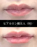 ヒアルロン酸注入（唇） before画像 サムネイル用