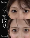 岩切医師による🔥クマ取り🔥 30日後 サムネイル用