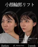 Dr岩切👑小顔整形👑 before画像 サムネイル用