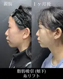 脂肪吸引 before画像 サムネイル用