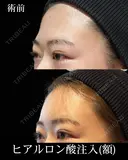 ヒアルロン酸注入 before画像 サムネイル用