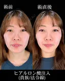 ヒアルロン酸注入(貴族/法令線) before画像 サムネイル用