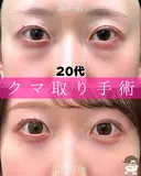 目の下のふくらみ取り・脂肪注入（目の下・ゴルゴライン） after画像 サムネイル用