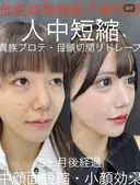人中短縮　貴族プロテーゼ　目頭切開　眼瞼下垂切開 before画像 サムネイル用