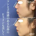 鼻複合オペ〜鼻尖形成3D(closed法)・耳珠軟骨移植 術後3ヶ月 before画像 サムネイル用