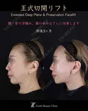 王式切開リフト 90日後 サムネイル用