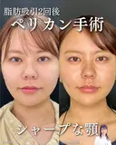 ペリカン手術 before画像 サムネイル用