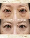 下まぶたのたるみ取り after画像 サムネイル用