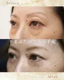 下まぶたのたるみ取り after画像 サムネイル用