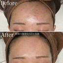 アクネスニードル before画像 サムネイル用