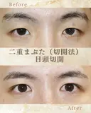 二重まぶた 切開法　目頭切開 before画像 サムネイル用