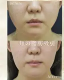 頬の脂肪吸引 after画像 サムネイル用