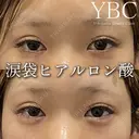 【🍒涙袋ヒアルロン酸🍒】 before画像 サムネイル用