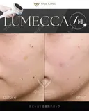 ルメッカ before画像 サムネイル用