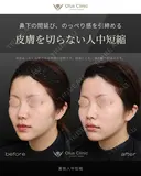 裏側人中短縮 before画像 サムネイル用