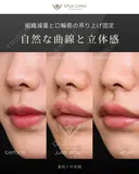 裏側人中短縮 7日後 サムネイル用