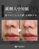 裏側人中短縮 7日後 サムネイル用