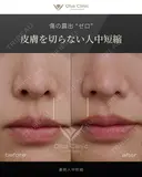 裏側人中短縮 before画像 サムネイル用