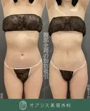 シリンジ法で細やか丁寧に吸引🌴コンプリート脂肪吸引【上下腹部・ウエスト・腰】形成外科専門医がご対応 after画像 サムネイル用