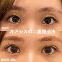 自然にぱっちり👀オアシスの【二重埋没法】形成外科専門医がご対応🌴瞼板法 after画像 サムネイル用