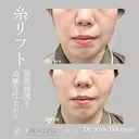 【形成外科専門医在籍】糸リフトPDO｜6本｜麻酔代込み｜切らずにリフトUP⤴️✨ before画像 サムネイル用