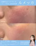 しみ・そばかすに✨ルメッカ before画像 サムネイル用
