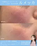 しみ・そばかすに✨ルメッカ after画像 サムネイル用