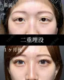 二重埋没 before画像 サムネイル用