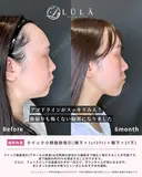 クイック小顔脂肪吸引（頬下+フェイスライン+顎下+エラ下） after画像 サムネイル用