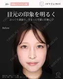涙袋ヒアルロン酸 before画像 サムネイル用