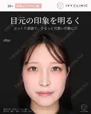 涙袋ヒアルロン酸 0日後 サムネイル用