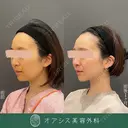 脂肪吸引のみですっきり✨コンプリート脂肪吸引【頬・顎下】形成外科専門医がご対応 after画像 サムネイル用