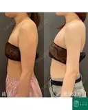 カリカリボディを目指す🌴コンプリート脂肪吸引【上腕全周～お背中一部】形成外科専門医がご対応 after画像 サムネイル用
