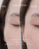 こめかみヒアルロン酸 before画像 サムネイル用