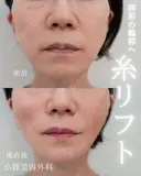 糸リフト 0日後 サムネイル用