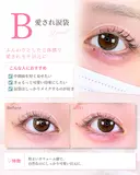 涙袋ヒアルロン酸 after画像 サムネイル用