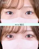 エターナル二重術(自然癒着法) after画像 サムネイル用